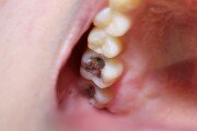 chelation, teeth cavity with the treatment, mercury