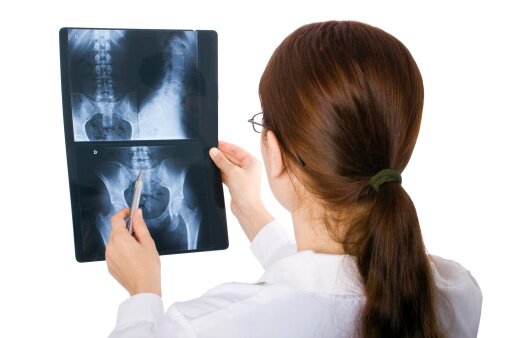 Female Doctor looking at Hip Fracture x-ray